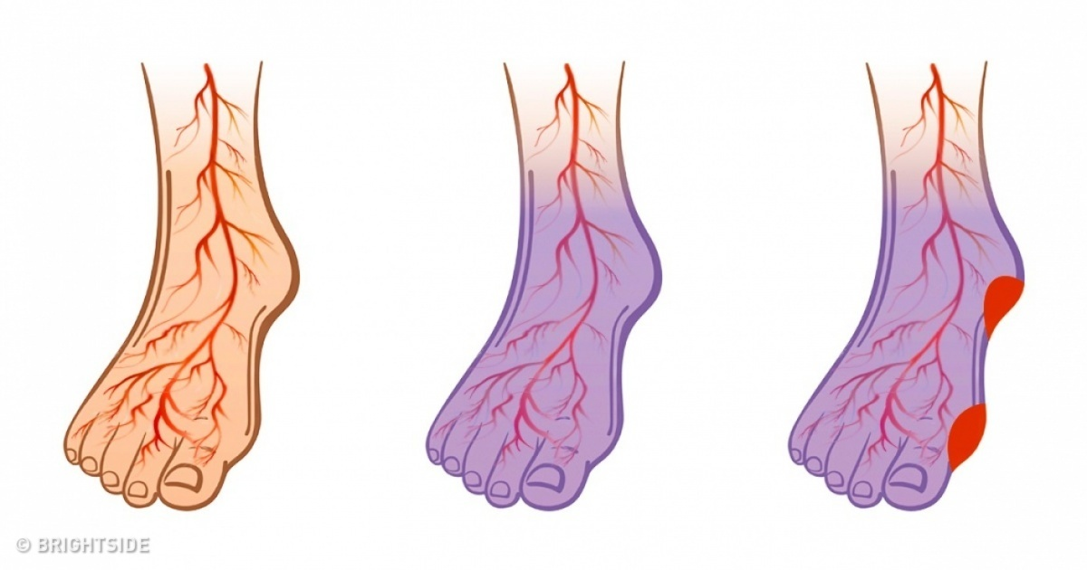 Varice picioare reci – Medicină și sănătate
